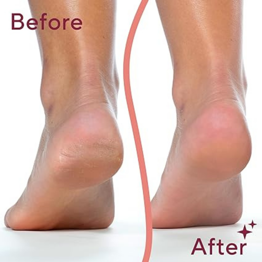 Callus Remover – مزيل الجلد الميت